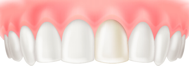 硬質レジン前装冠のイラスト