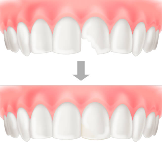 ダイレクトボンディングのイラスト