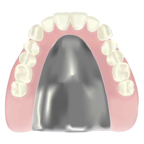 チタン床義歯のイラスト