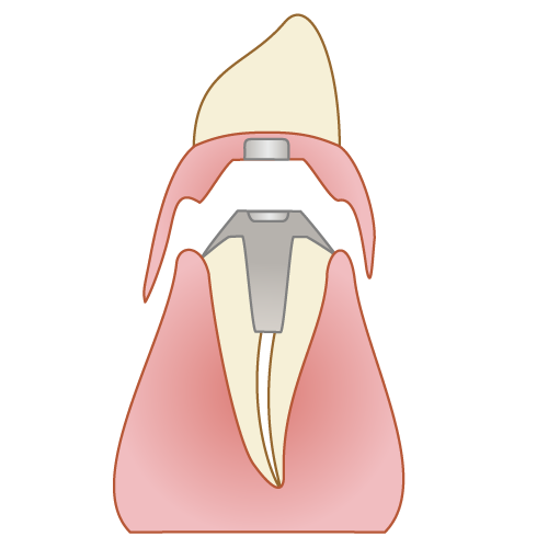 マグネットデンチャーのイラスト